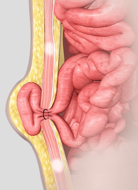 Best Hernia Surgeons in Nizamabad